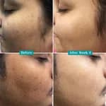 Pilgrim 10% Vitamin C Serum 30ml for Glowing Skin|With 5% Niacinamide, Hyaluronic & Glycolic Acid|Fades Dark Spots, Pigmentation|For All, Oily, Combination, Normal Skin |Beginner Friendly - Men, Women